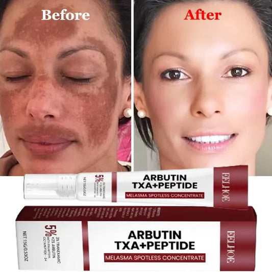 Powerful Spot-Removing Whiten Cream Brighten Skin Fast Eliminates Melanin Pigmentation Melasma Dark Spots Skin Care New 2024