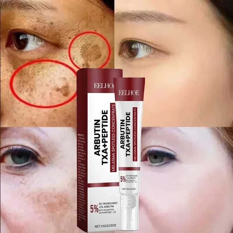 Powerful Spot-Removing Whiten Cream Brighten Skin Fast Eliminates Melanin Pigmentation Melasma Dark Spots Skin Care New 2024